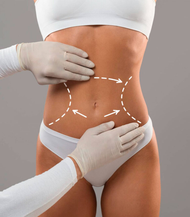 Abdominoplastia
