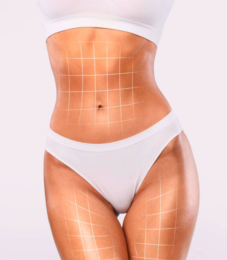 Lipoaspiração